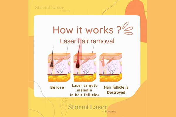 مرکز لیزر و مراقب از پوست طوفان Stormi Laser & Skincare